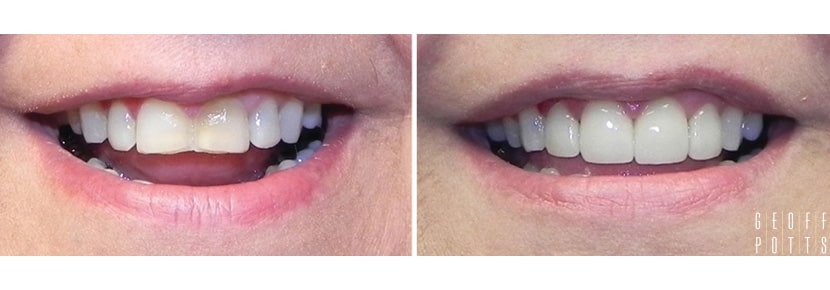 Patient before and After photo 2