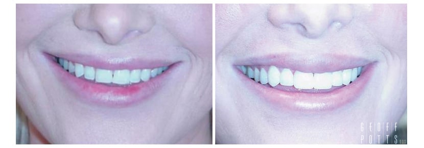 Patient before and After photo 6